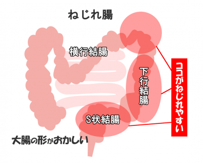 ねじれ腸